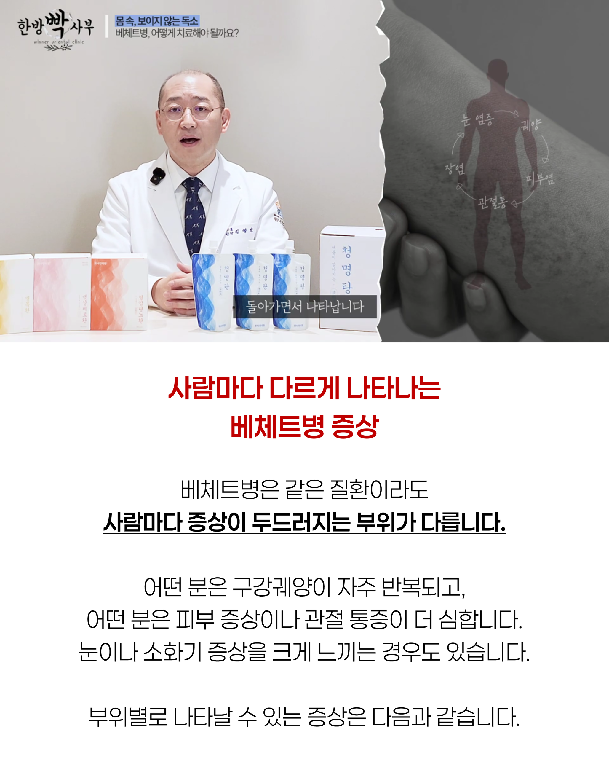 베체트병4