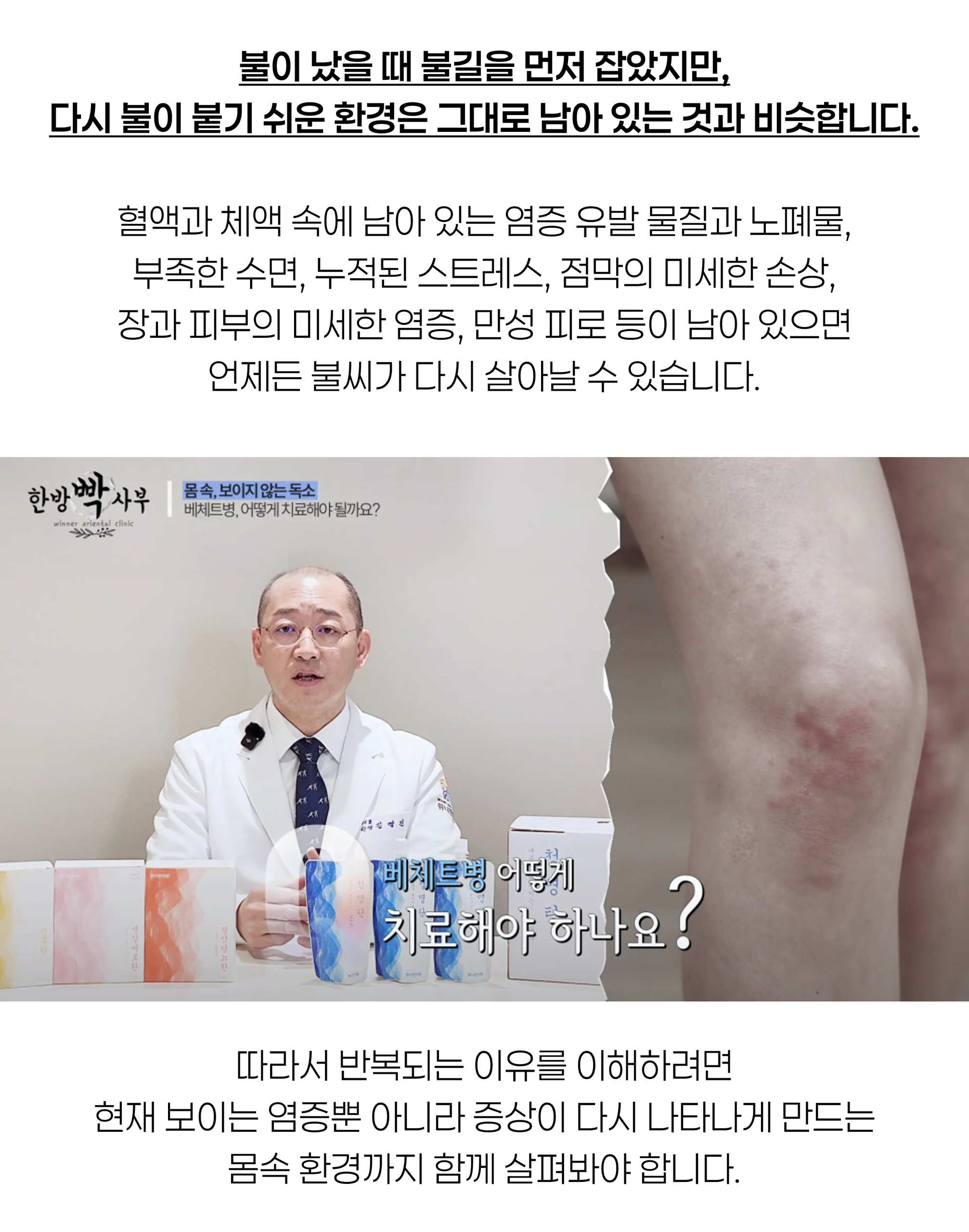 베체트병6